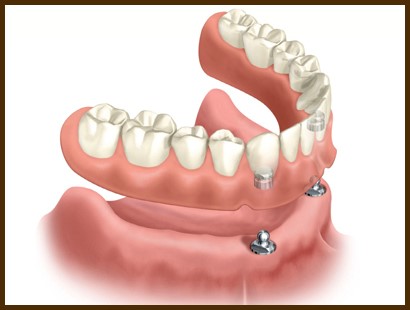 Zirconium Dentures Adelanto CA 92301